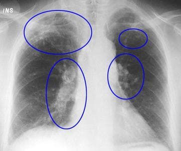 Chest X-ray showing several abnormal areas highlighted with blue circles, indicating possible irregularities or lesions in the lungs and central chest area, as part of a Hostplus member health screening initiative.